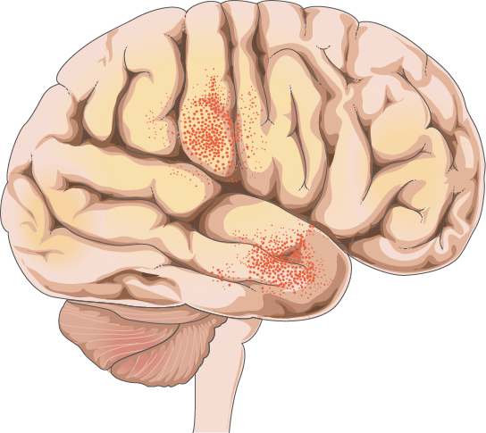 Meningitis - Meningitis (544x485)