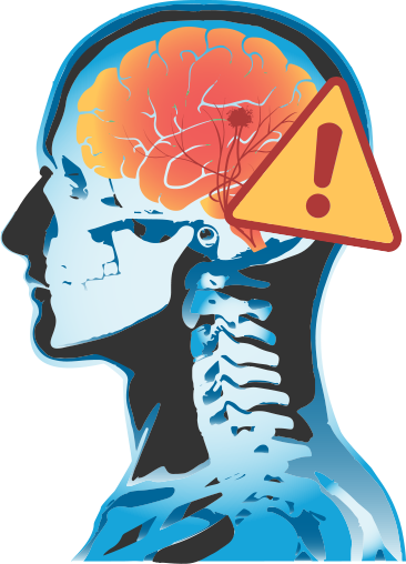 Stroke - Brain Stroke Transparent Backgrond (366x508)