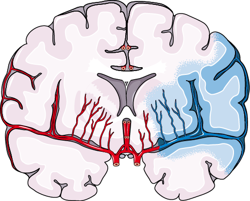 Download The Image - Stroke (515x416)