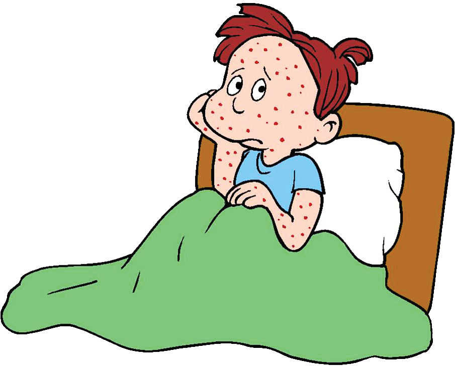 Chicken Pox Clipart (904x734)