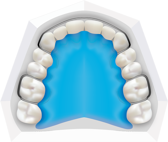 Removable Braces At Toothbeary Removable Retainers - Illustration (700x586)