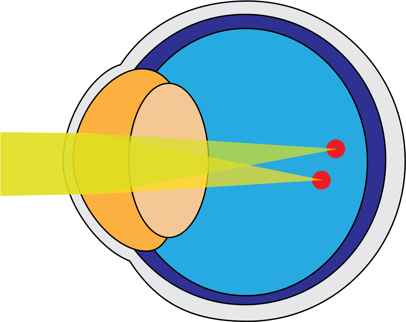 Astigmatism (2000x1656)
