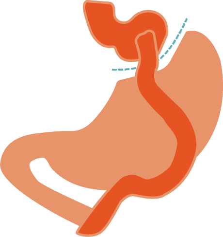 Laparoscopic Bypass Surgery - Illustration (460x487)