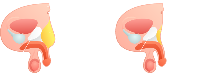 Circumcision - Male Pubic Fat Pad Removal (644x236)