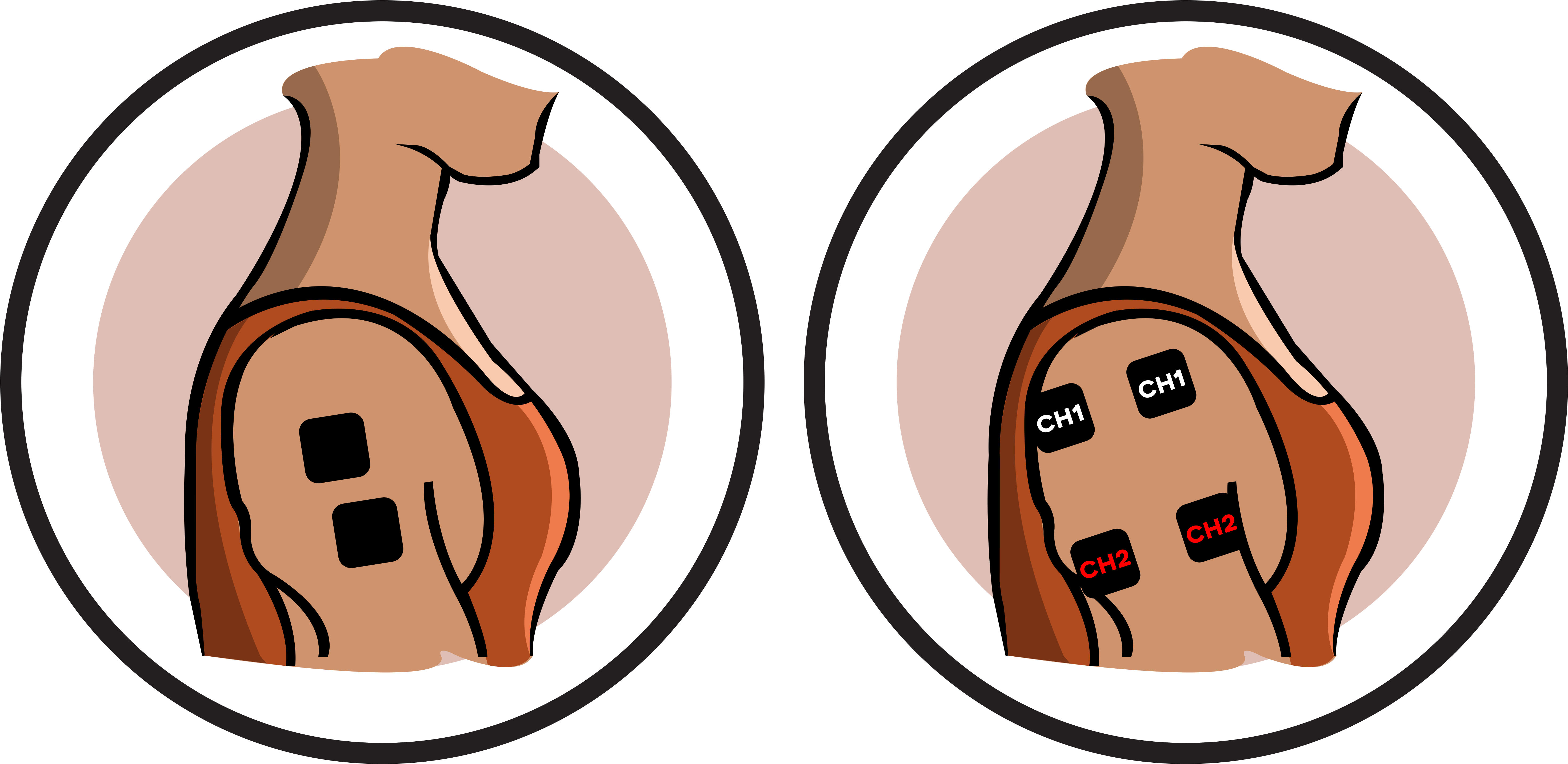 Shoulder Electrode Pad Placement - Transcutaneous Electrical Nerve Stimulation (6000x3000)