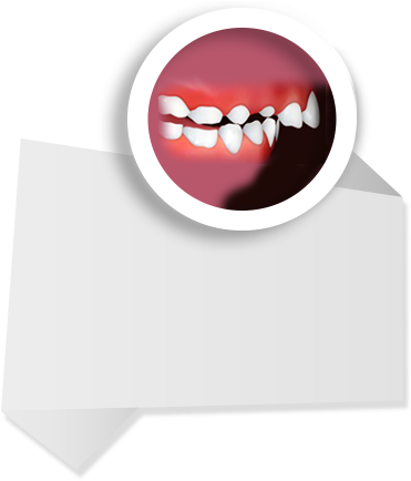 Upper Frontteeth - Protrusion - - Tongue (396x439)