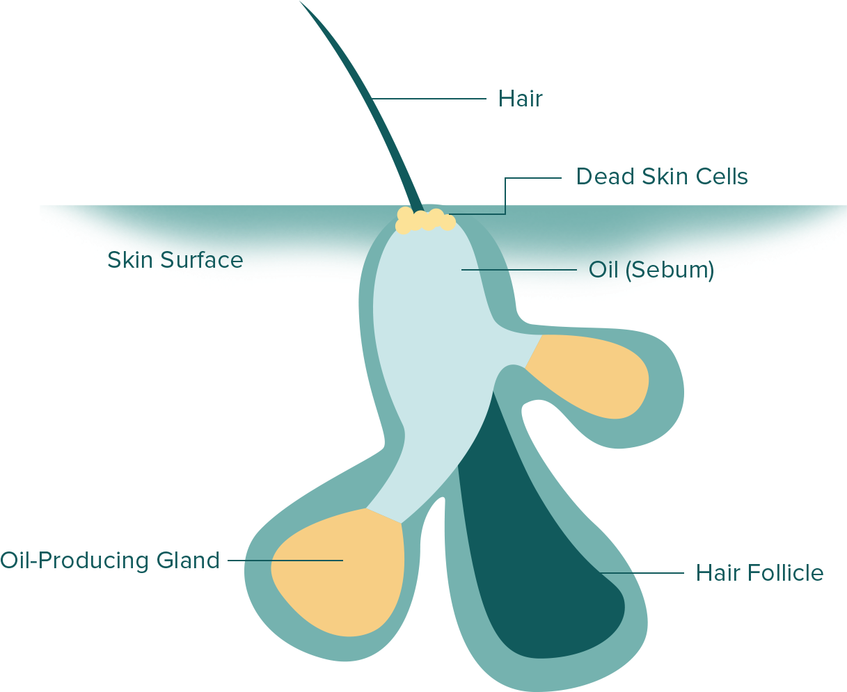 What Is Acne - Acne (1228x1000)