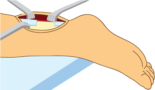 Achilles Tendon (504x288)