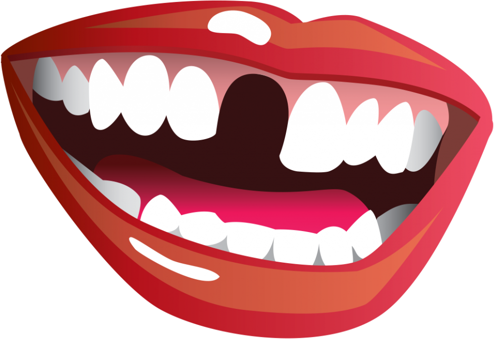 Smile Missing Tooth (1024x706)