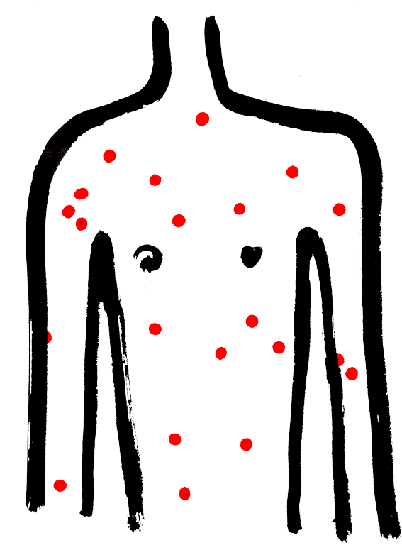 Chicken Pox - Chicken Pox (1400x774)