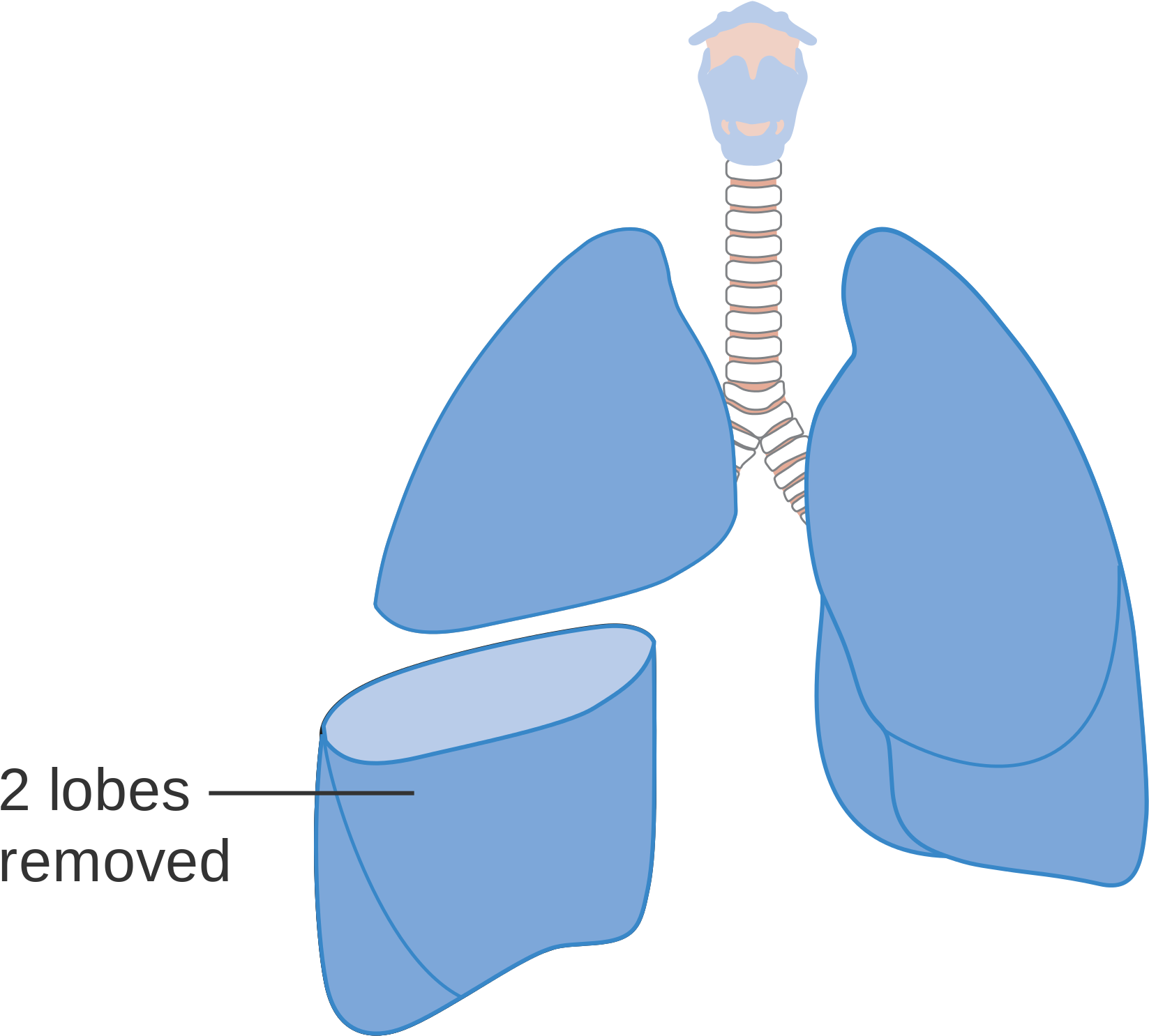 Open - Bilobectomy Lung (2000x1712)