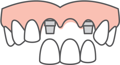 Multiple Tooth Replacement - Multiple Tooth Replacement (520x261)
