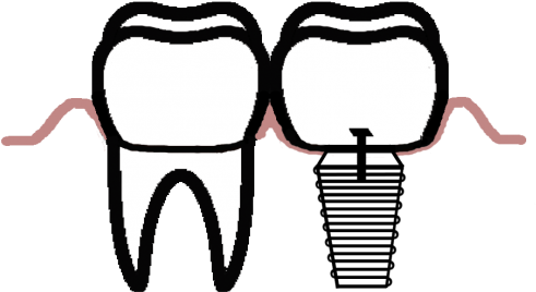 Dental Implants - Dental Implants (960x397)