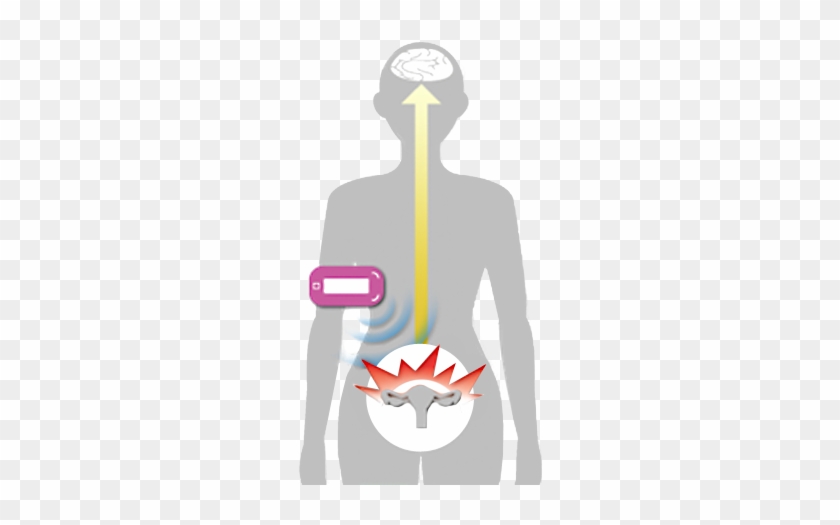 탠스 의 원리 - Transcutaneous Electrical Nerve Stimulation #522984