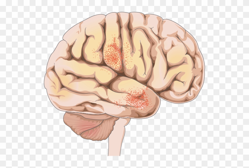 Meningitis - Meningitis #542297