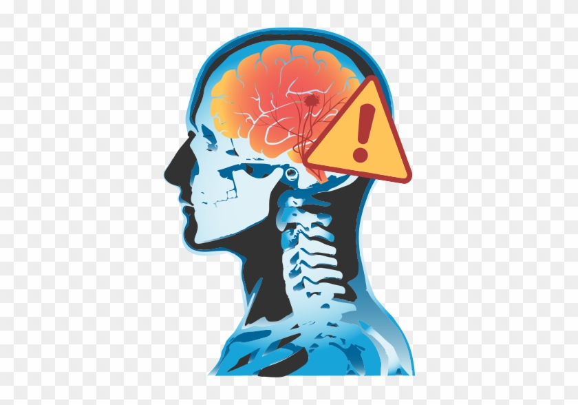 Stroke - Brain Stroke Transparent Backgrond #543550