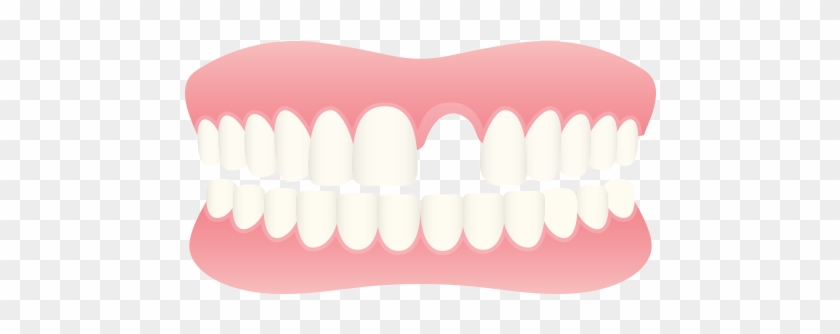 Replacement Of Missing Teeth - Teeth In Row Vector #563253