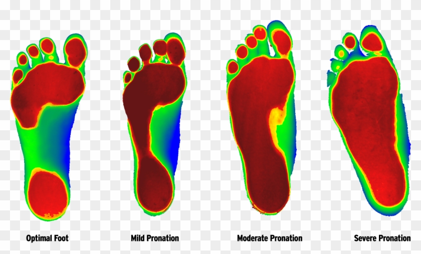 Foot Types - Foot Levelers #575701
