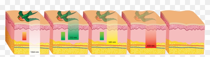 Unwanted Dark And Multi-colored Tattoos Can Be Safely - Illustration #575855