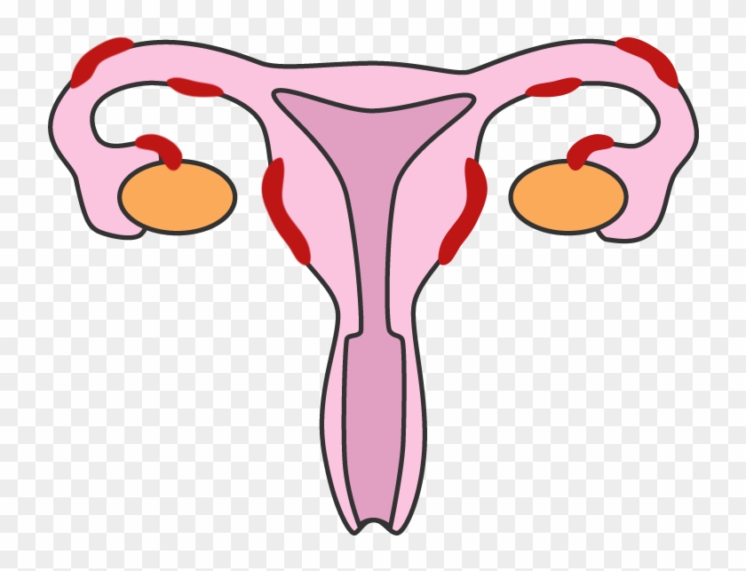 Endometriosis V2 - Health #577475