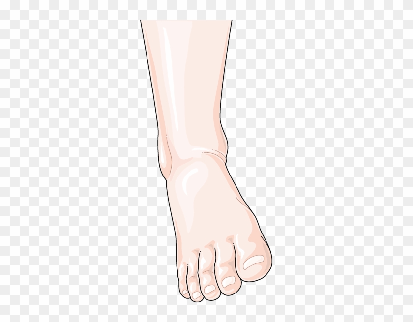 Download The Image - Sprained Ankle #641064