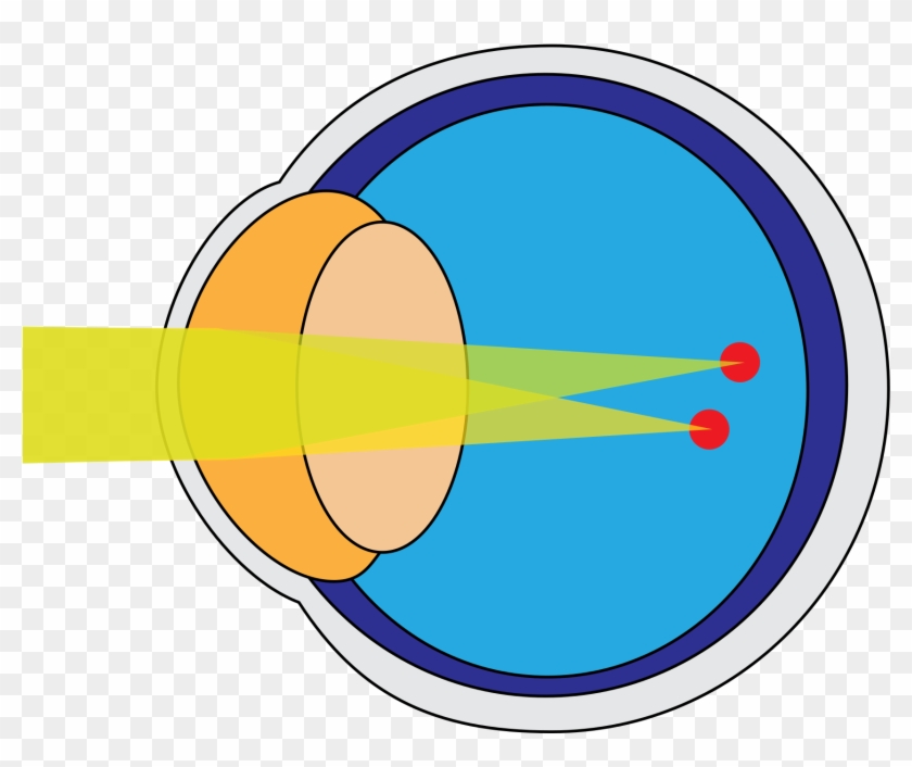 Astigmatism #739726