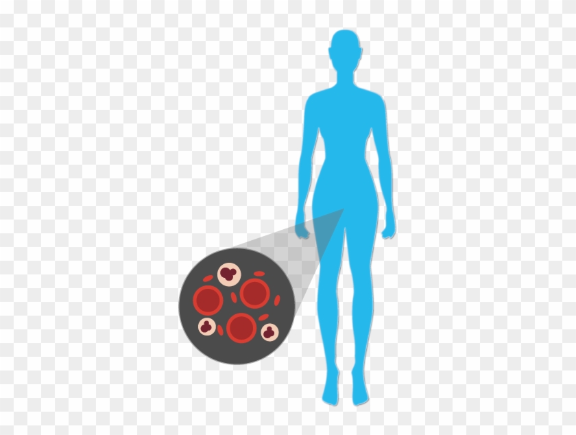 Build Up Of Substances In Veins, The Deposit Of Plaque - Build Up Of Substances In Veins, The Deposit Of Plaque #919538