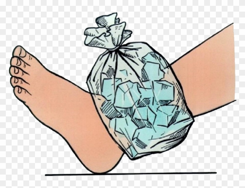 Applying Heat Or Ice Compression - Ice On Sprained Ankle #172880