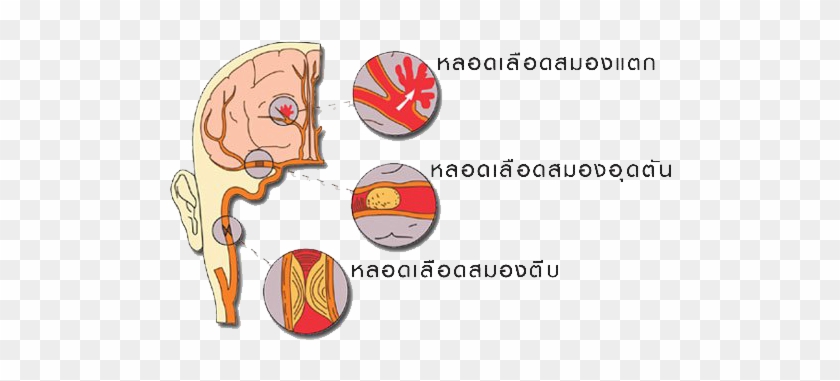 Stroke #1036612