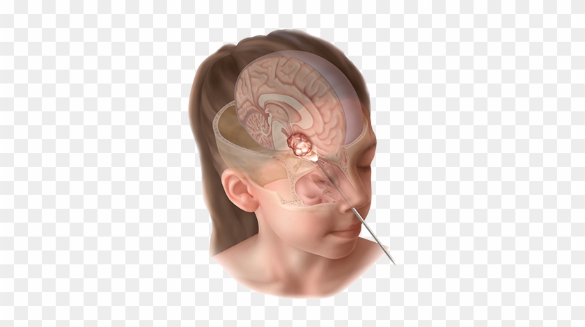 Endoscopic Endonasal Approach To Skull Base Tumors - Surgery #1078901