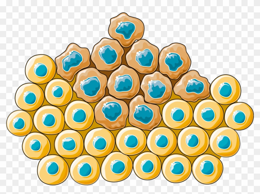 Carcinoma - Microbubbles Drug Delivery #187712