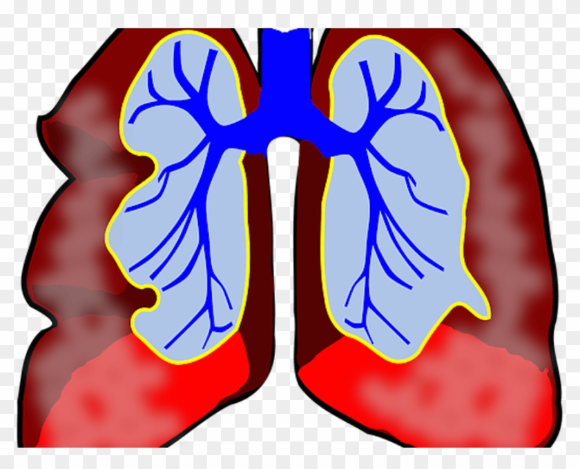 Allergic Asthma Signs Symptoms And Treatments - Lungs Clip Art #1139143