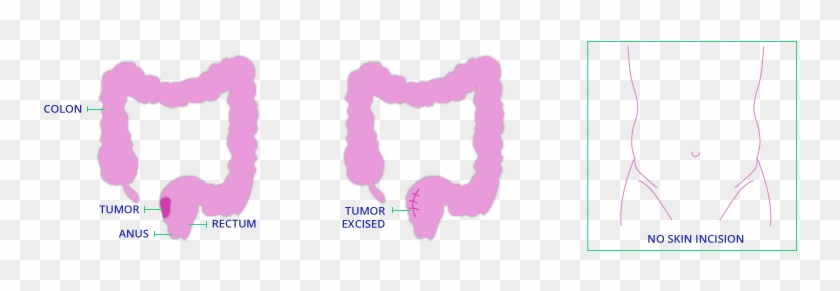 Local Excision Diagram For Tamis Surgery - Illustration #1198163