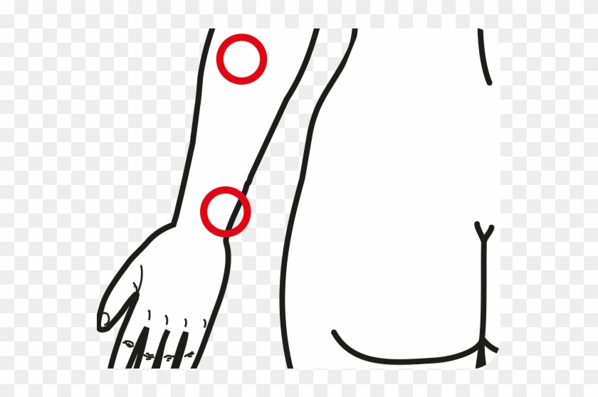 Tendinitis Of The Hand Extensors - De Quervain Syndrome #1256446