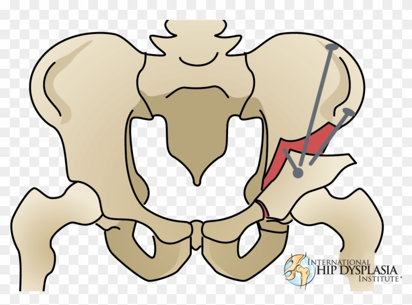 [ ] Enlarge - Triple Pelvic Osteotomy Human #1284868