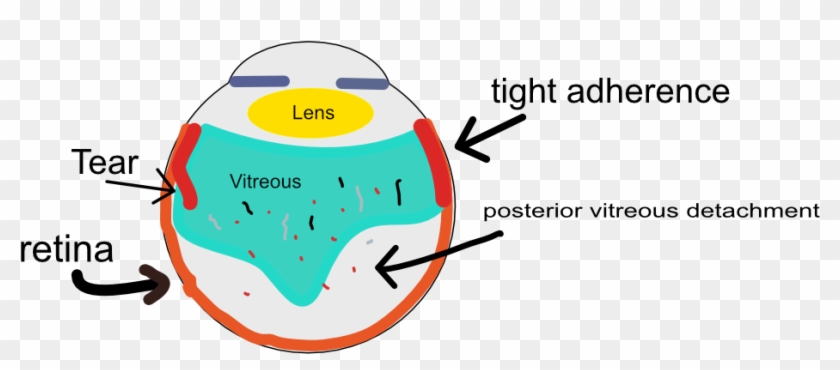 In Fact, It Really Cannot Let Go Of The Retina Beyond - Vitreous Body #1399488