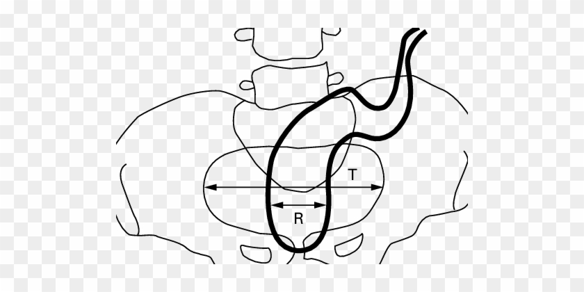 Determination Of The Rpr - Pelvis #1433983