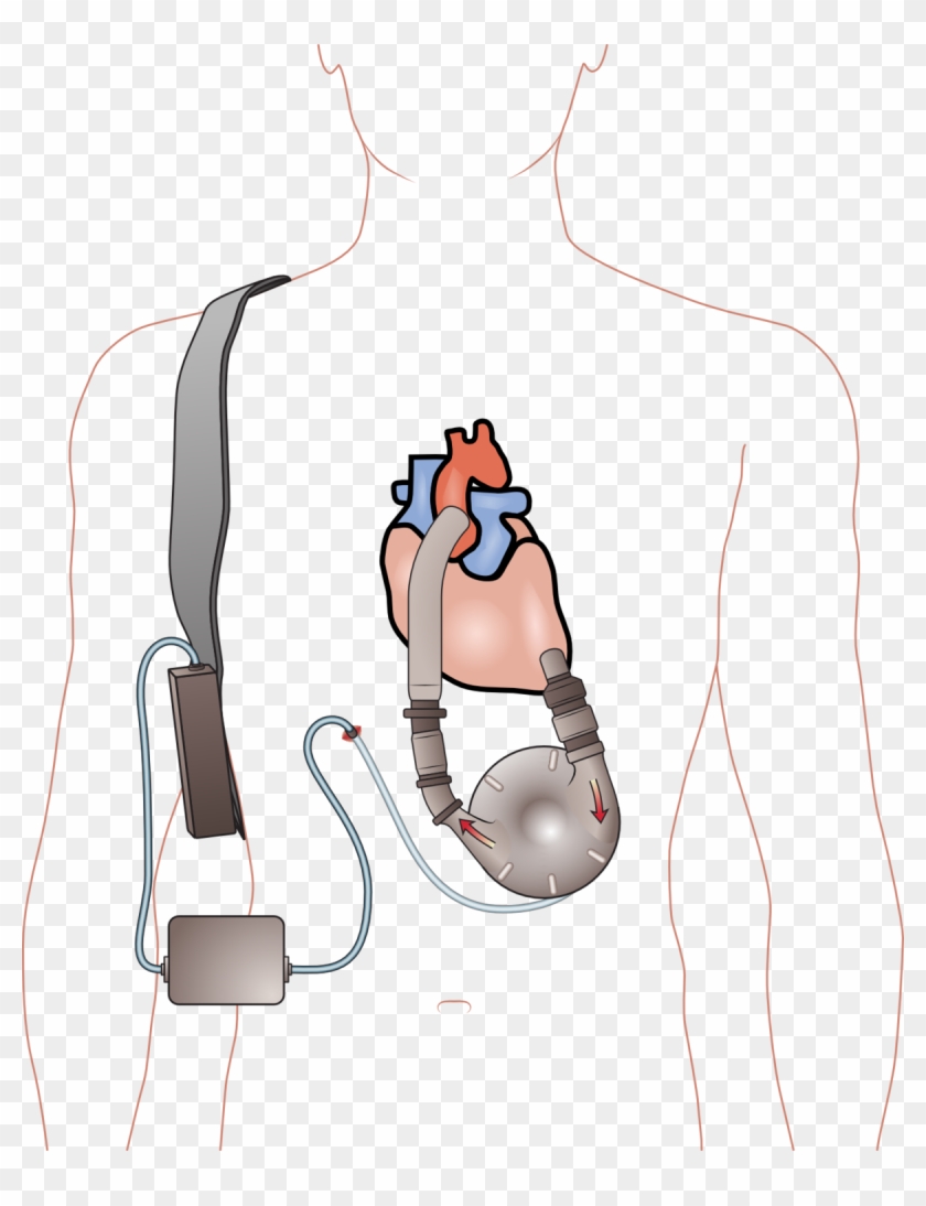 Aparato Para El Corazon #1434991
