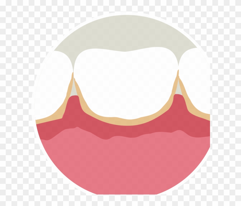 Illustration Of Swollen, Bleeding Gums - Bleeding On Probing #1440841