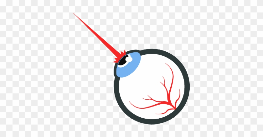 Lasik Surgery - Lasik Surgery Clipart Png #1446539
