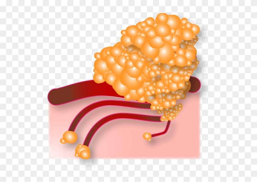 At This Advanced Stage, Tumors Have Spread To Multiple - Illustration #1446554