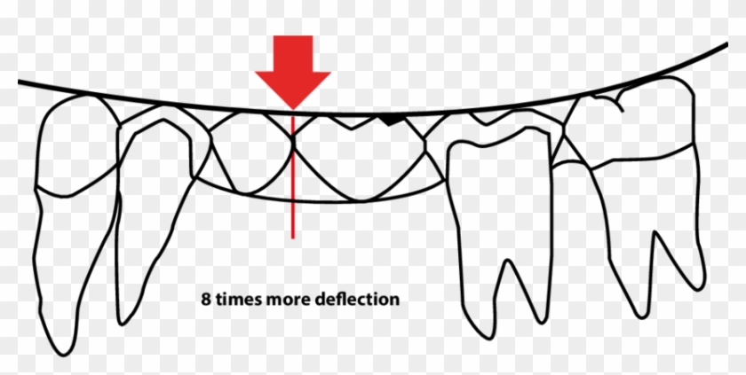 Deflection Of A Fixed Dental Prosthesis Is Directly - Fixed Prosthodontics #1470654