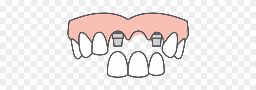 Multiple Tooth Replacement - Multiple Tooth Replacement #1578918