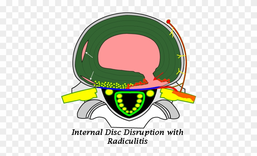 So It Is Absolutely Possible To Have An Mri Scan Reported - Annular Tear Disc #1667663