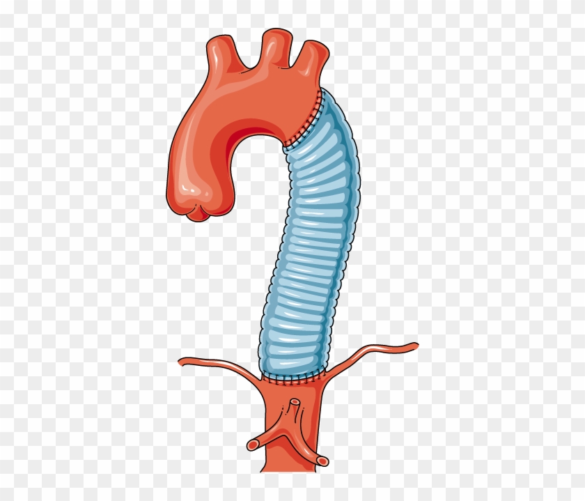 Equipment - Aneurysm #403482