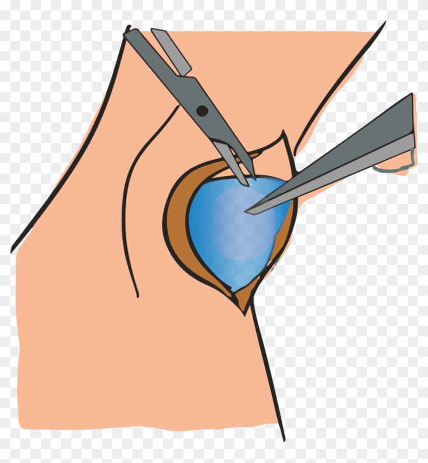 Removing Ganglion Cyst Through Surgery - Removing Ganglion Cyst Through Surgery #454410